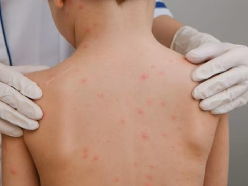 Meningite provoca três mortes no Acre em 2026; bactéria é responsável por todos os óbitos